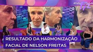 Confira o resultado impressionante da harmonização facial de Nelson Freitas | Fofocalizando 06/03/26