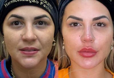 Deolane Bezerra refaz harmonização facial após complicação com preenchimento