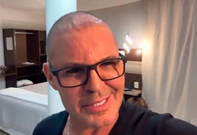 Eduardo Costa surge careca após procedimento capilar