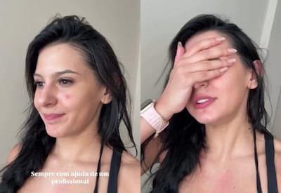 Ana Castela inicia tratamento forte contra acne e desabafa: "Sofrendo!"