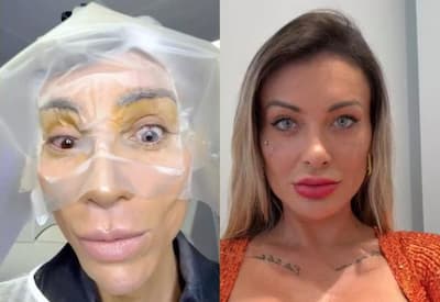Mudar a cor dos olhos? Médico faz alerta sobre riscos do procedimento