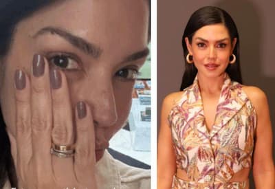 Thais Fersoza surge com rosto inchado e diagnóstico é revelado