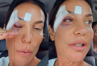 Ivete Sangalo tranquiliza fãs após acidente doméstico