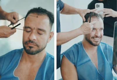 Diogo Nogueira passa por novo transplante capilar e mostra bastidores