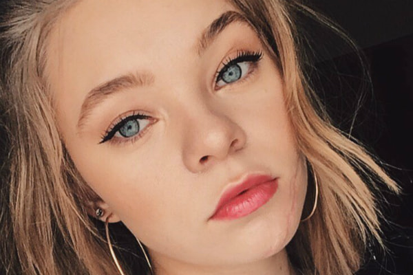 a atriz Taylor Hickson ficou com uma grande cicatriz do lado esquerdo do rosto