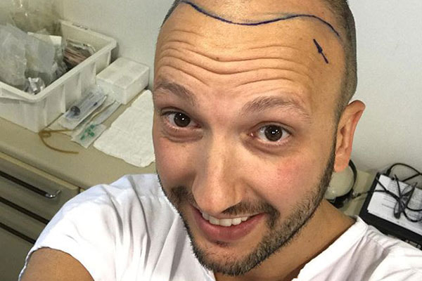 Murilo Bordoni antes de transplante capilar