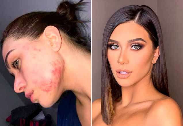 Flavia Pavanelli antes e depois do tratamento contra acne