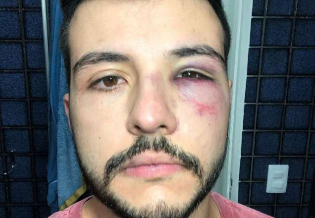 O apresentador Matheus Ribeiro com o olho direito roxo