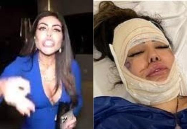 Liziane Gutierrez mostra procedimento para retirar produtos de harmonização facial