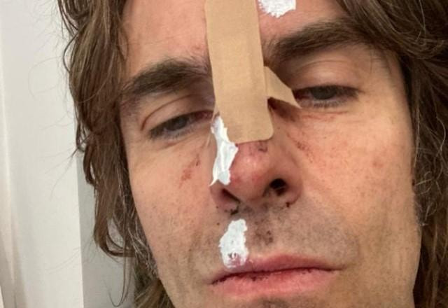 Liam Gallagher mostra ferimentos no rosto após acidente de helicóptero