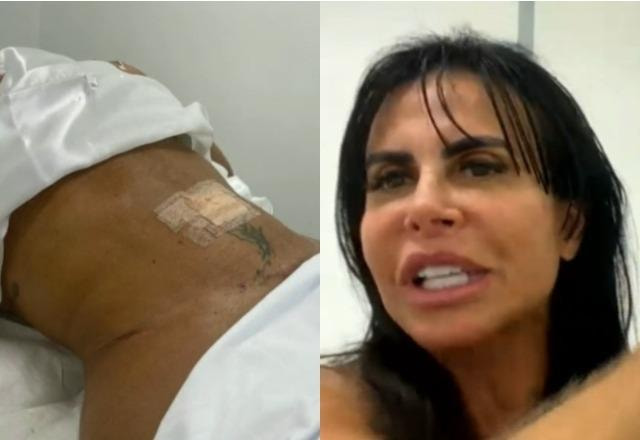 Resultado da Lipo HD feita por Gretchen à esquerda; Gretchen em chamada com o Fofocalizando à direita