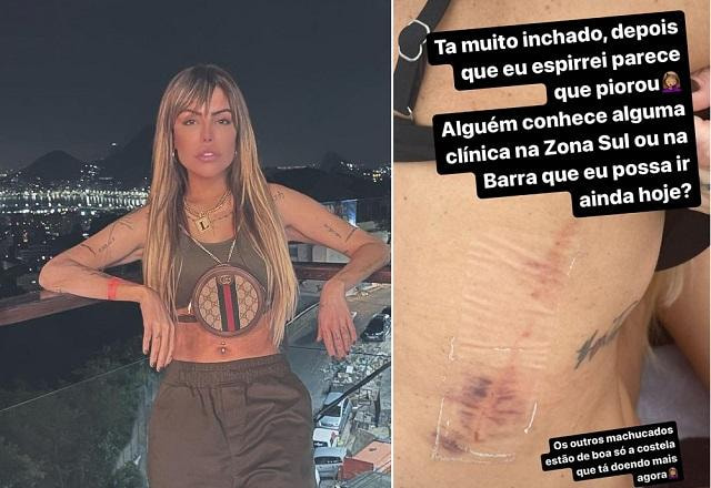 Liziane Gutierrez e foto de hematoma na costela