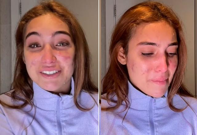 Montagem com fotos de Vanessa Lopes chorando ao desabafar sobre problema com acnes espinhas