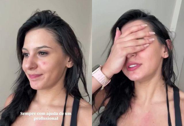 Ana Castela mostra rosto com acne e inicia tratamento forte: Sofrendo!