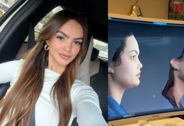 Após perder peso, Suzanna Freitas mostra resultado de tratamentos estéticos