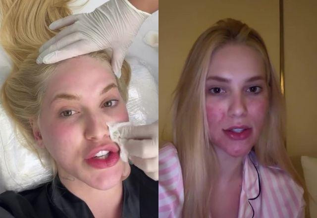 Virginia Fonseca mostra procedimento no rosto e detalha tratamento para marcas na pele