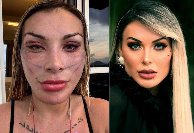 Andressa Urach com o rosto inchado e Andressa Urach antes